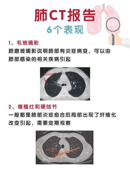 2020-2022新冠疫情期间流行株白肺风险与复阳关联分析及四川专家建议