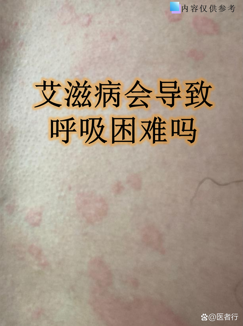 奥密克戎JN1亚型失味觉现象与复阳关联解析及防控建议