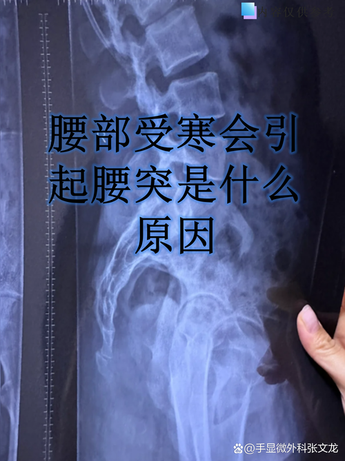 XBB变异株致腰背痛解析：2020-2022年新冠疫情期间的症状误判与应对建议