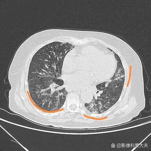 新冠肺炎咳痰困难与复阳关联性分析