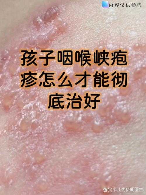 奥密克戎JN1引发咽喉肿痛是否复阳？广州专家解析疫情新特征