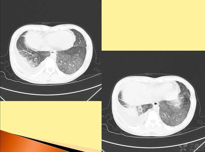 31省份多点散发，山东病例为何三连跳？