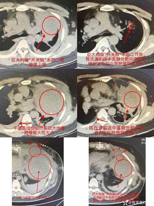 长三角防控网的针尖破口：丹徒区新增12例确诊病例透视