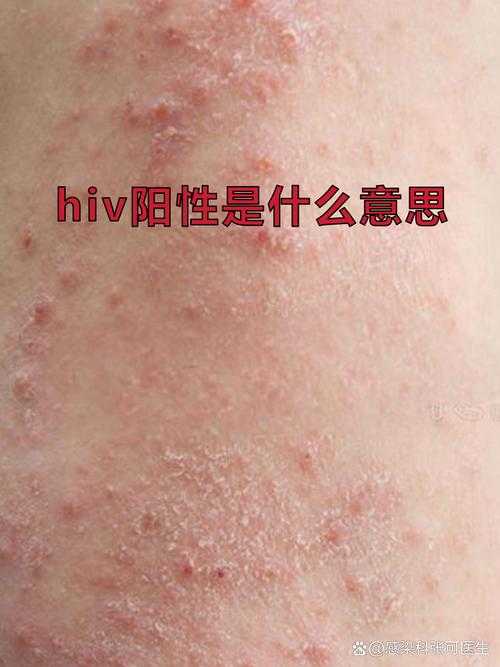 奥密克戎亚型低烧不退现象解析：复阳症状还是病毒特性？