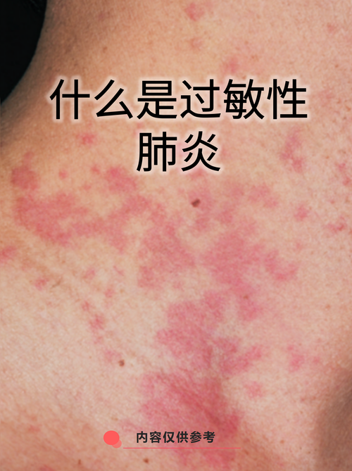 奥密克戎JN1肺部感染是否复阳？贵州专家解析2020-2022疫情关键点