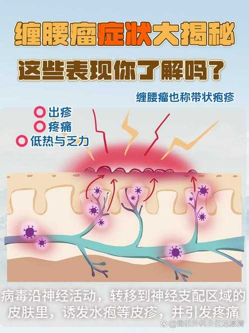 变异毒株防控关键：腰背痛症状与复阳关联解析