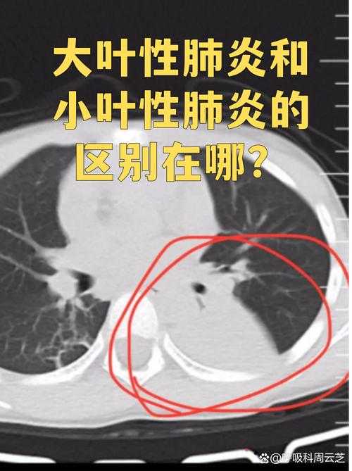 【2020-2022新冠变异株干咳无痰症状解析与复阳风险评估】